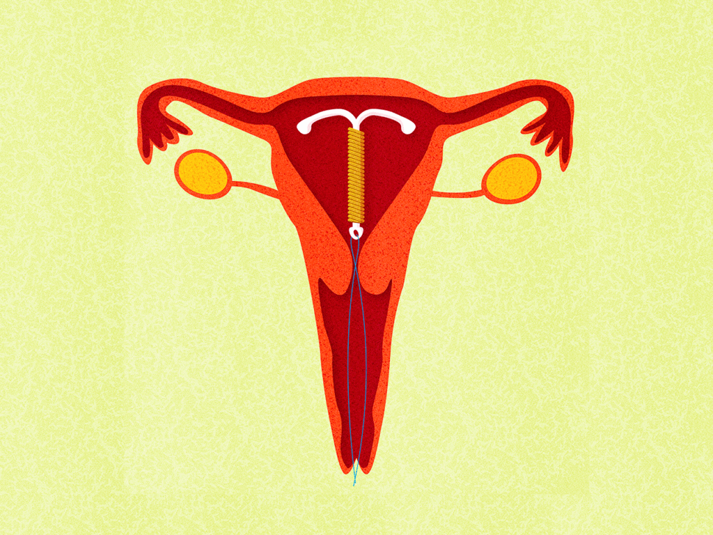 uterus, iud