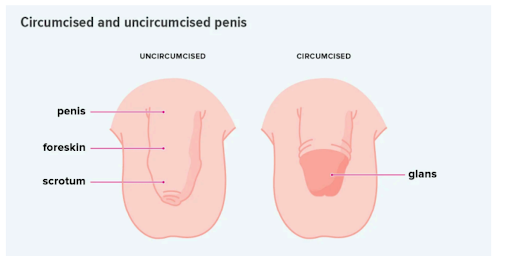 Graphic showing the difference between a circumcised versus uncircumcised penis.