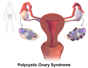 Graphic illustrating cysts in the ovary