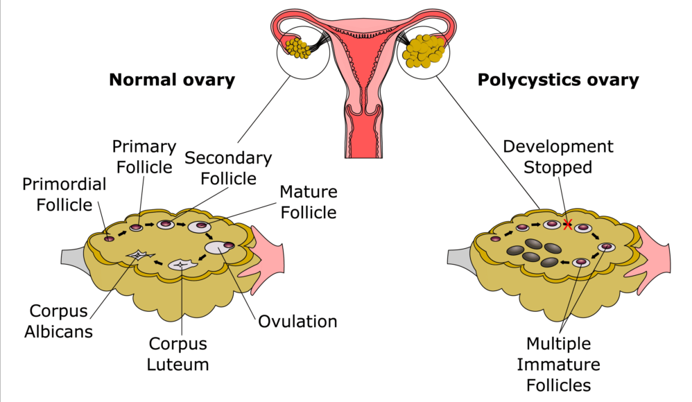 Diagram illustrating the differences between a normal ovary and an ovary with cysts.