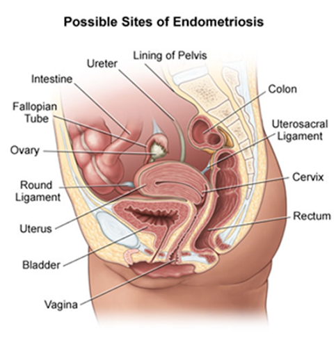 Endometrial tissue outside the uterus triggers inflammation, cysts and organ adhesions. Source: John Hopkins Medicine
